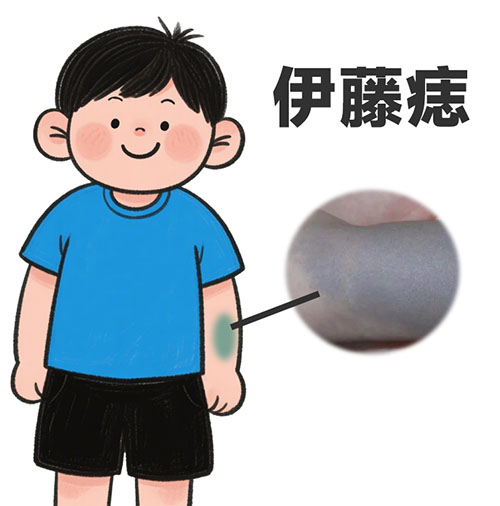 伊藤痣不治疗会恶化吗？南京胎记专科医院哪家好？